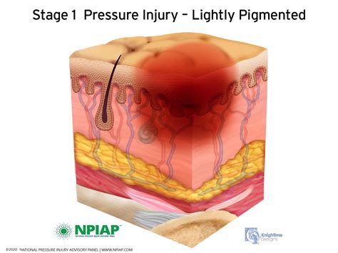 Pressure Ulcer Stage 2