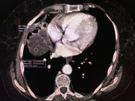 Lipoid pneumonia | Radiology, Pneumonia, Lunges