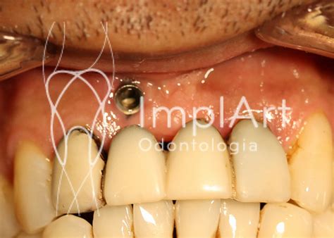 Implante dentário mal posicionado Implante dentário mal po Flickr