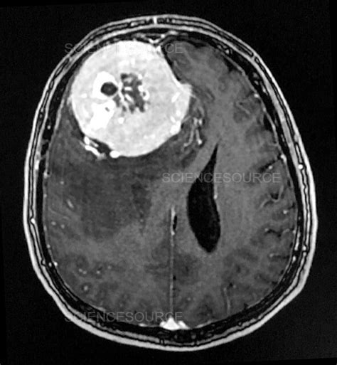 Photograph Large Frontal Meningioma Mri Science Source Images