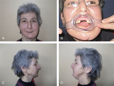 Postoperative View After 5 Years A Anterior View B Intraoral View