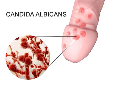 Point Rouge Bouton Sur Le Gland Est Il Un Champignon Ou Un Virus