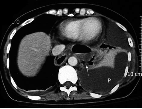 Tearing Perforation Of The Esophagus As Related To Achalasia Pictures