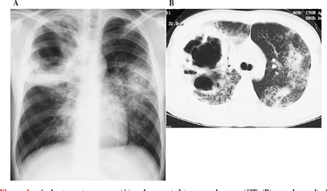 Figure 1 from Non-localized Mycobacterium avium lung disease ...