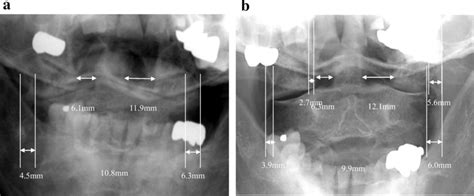 A Preoperative Open Mouth View Showing Mm As The Sum Of