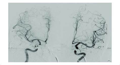 One Month Post Endovascular Coil Embolization Follow Up Catheter