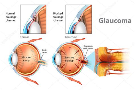 Glaucoma Ilustración Que Muestra Glaucoma De ángulo Abierto Presión