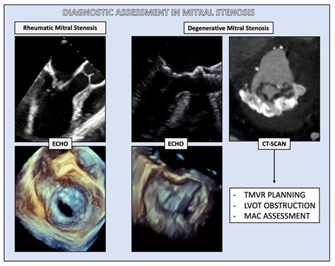 Jcdd Free Full Text Rheumatic And Degenerative Mitral Stenosis