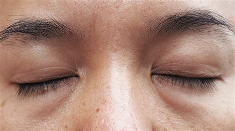 Lymphstau Augen Tipps Gegen Geschwollene Augen Am Morgen