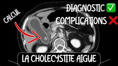 Radiologie La cholécystite aiguë pour l EDN base pour tout médecin