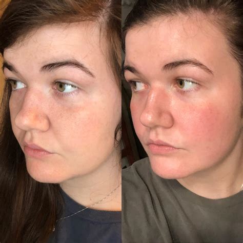 Skin Concerns Random Redness On Cheeks Details In Comments Rskincareaddiction