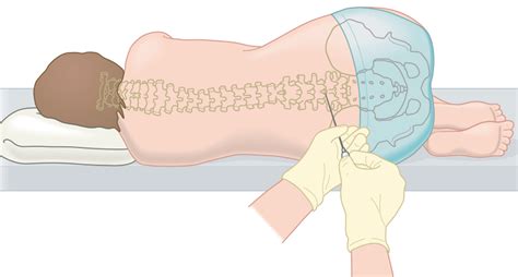 An Intrathecal Injection Is Directed Into - mapametawan