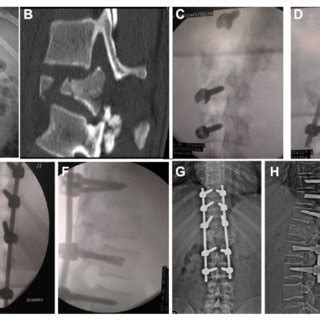 Safe Surgical Technique For Reducing TLFD A Anteroposterior