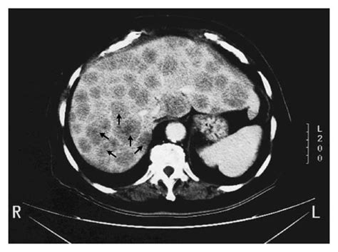 Liver Metastases From Lung Cancer — Nejm