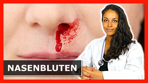 NASENBLUTEN ERSTE HILFE Tipps Zum Stoppen Der Blutung YouTube