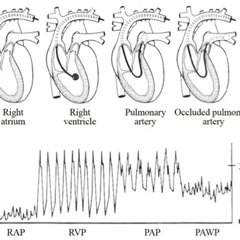 Haemodynamic Pressure Tracings Obtained During The Insertion Of A Download Scientific Diagram