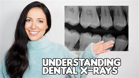 How To Understand Your Dental X Rays Dental Hygienist Explains Youtube