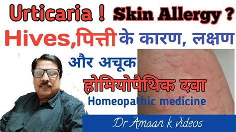 Urticaria Hives पित्ति Best Homeopathic Treatment Of Urticaria