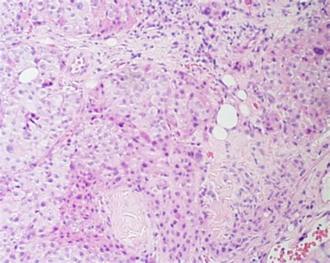 H & E section of the metastatic Hurthle cell carcinoma. | Download ...