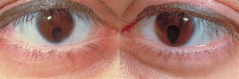 Bilateral Iris Colobomas Eccles Health Sciences Library J Willard Marriott Digital Library