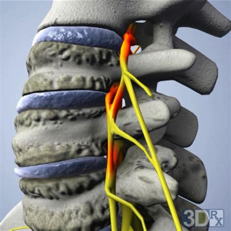 La sténose foraminale et la sténose spinale cervicale causes