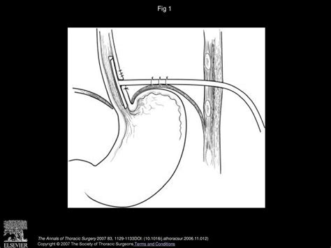 Modified T Tube Repair Of Delayed Esophageal Perforation Results In A