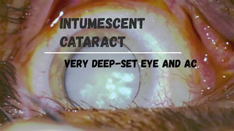 Cataract Intumescent In Very Deep AC Phaco CTR YouTube