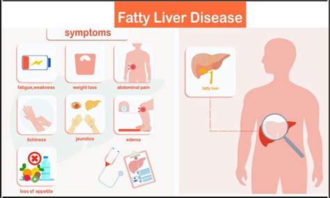 Fatty Liver Disease: Causes, Risk Factors, Symptoms, Treatment