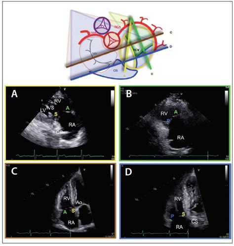 Cardiac Interventions Today - Echocardiography for Tricuspid Valve ...