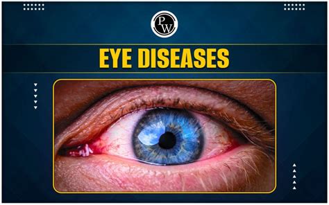 Eye Diseases: Introduction And Types