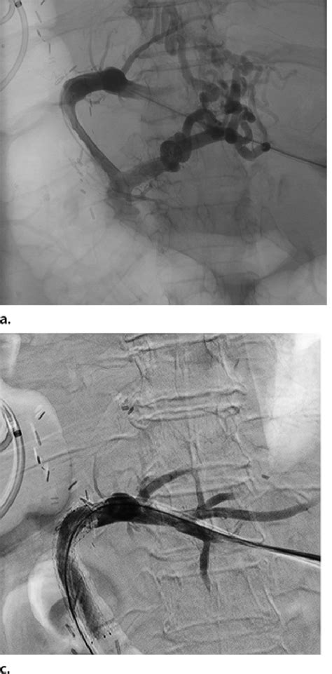 Percutaneous Transhepatic Recanalization Of The Portal Vein In A