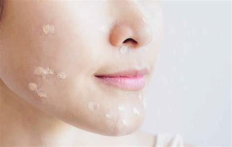 Dr Vera Toh Is It Safe To Wear Makeup With Acne And Rosacea Sl