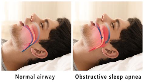 How To Improve Obstructive Sleep Apnea Symptoms