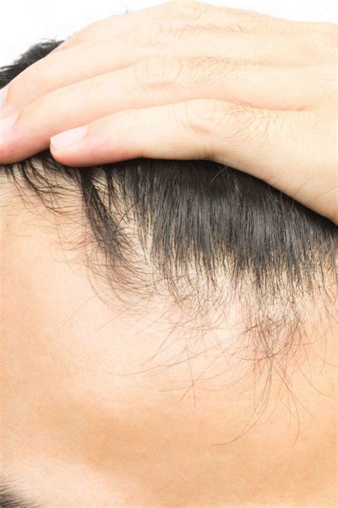 How To Tell If You Have A Receding Hairline