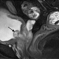 Mrisagittal Section T Weighted Phase Bump Of Posterior Urethral