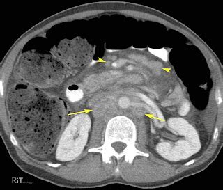 Shotty inguinal lymph nodes - ploraers