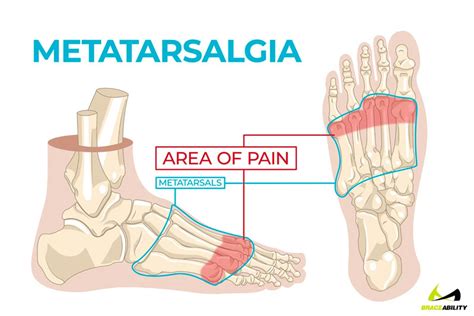 Facts About Forefoot Pain A K A Metatarsalgia