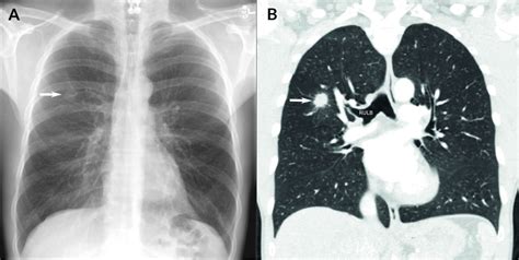 Lung Cancer Xray Tumor