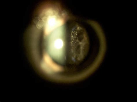 Before and after vitreolysis : r/EyeFloaters