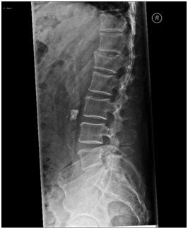 Vertebral Compression Fractures Pain Treatment Westmead, NSW ...