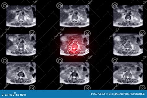 MRI L-S Spine or Lumbar Spine for Diagnosis Spinal Cord Compression ...