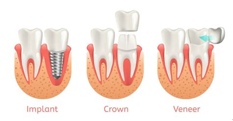 Veneers vs Crowns- What's the Difference? - VIDA Wellness and Beauty