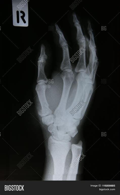 X Rays Images Bone Image And Photo Free Trial Bigstock