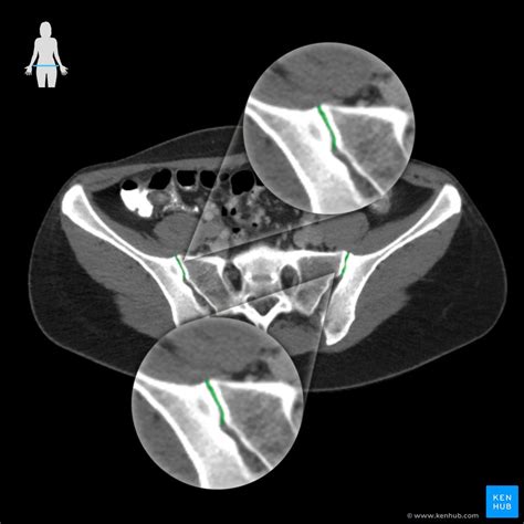 Sacroiliac joint: Anatomy and ligaments | Kenhub