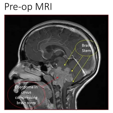 Case Study Series Clival Chordoma Neurosurgeons Located In Long