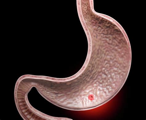 Stomach Ulcer Photograph by Tim Vernon / Science Photo Library