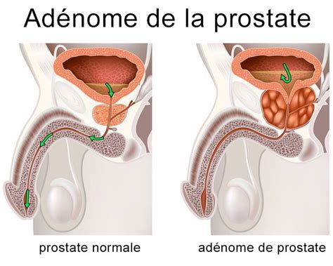 Cancer De La Prostate Urofrance