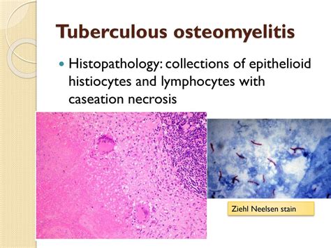 Musculoskeletal Block Pathology Osteomyelitis And Septic Arthritis