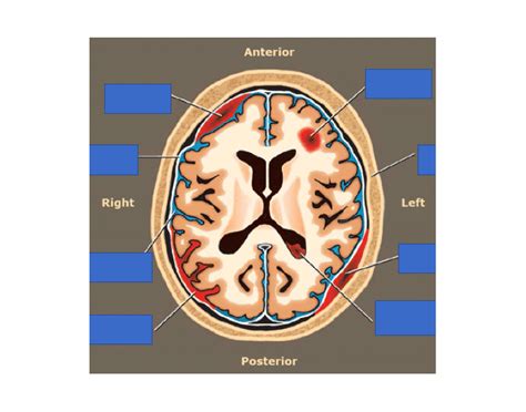 hematoma types 2 Quiz