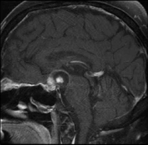 Postoperative T1-weighted sagittal MRI. In the suprasellar cistern just ...